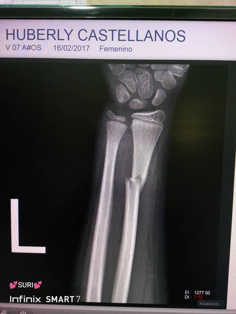 Greetings, I ask for your help in good faith, this is my 7 year old daughter who fractured her arm.